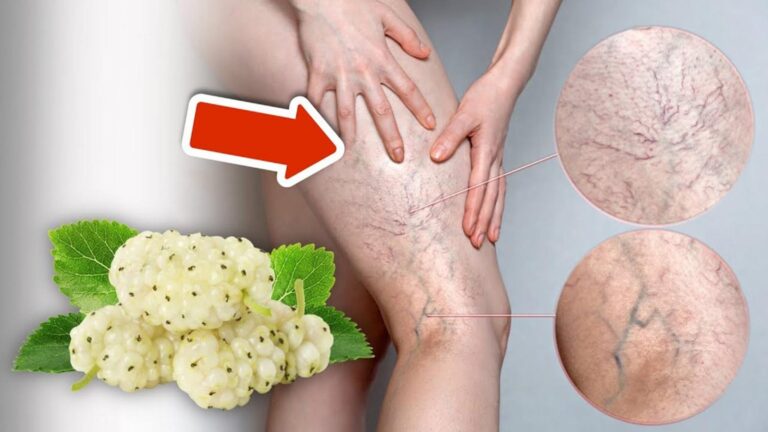 5 skutecznych sposobów na trwałe pozbycie się żylaków i poprawę zdrowia!