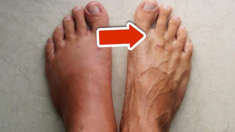10 sposobów na naturalne zmniejszenie obrzęków nóg i stóp już dziś!