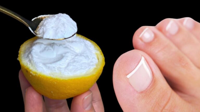Najlepsze 5 naturalnych sposobów na usunięcie grzyba paznokci – odkryj je teraz!